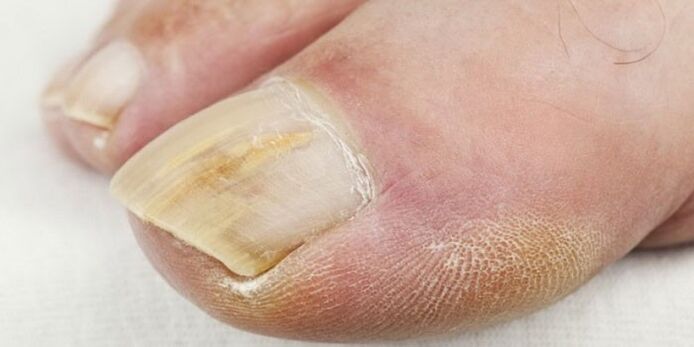 symptômes de mycose des ongles des pieds