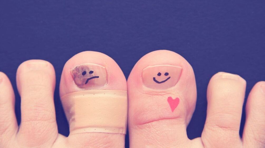 Pourquoi la mycose des ongles est dangereuse