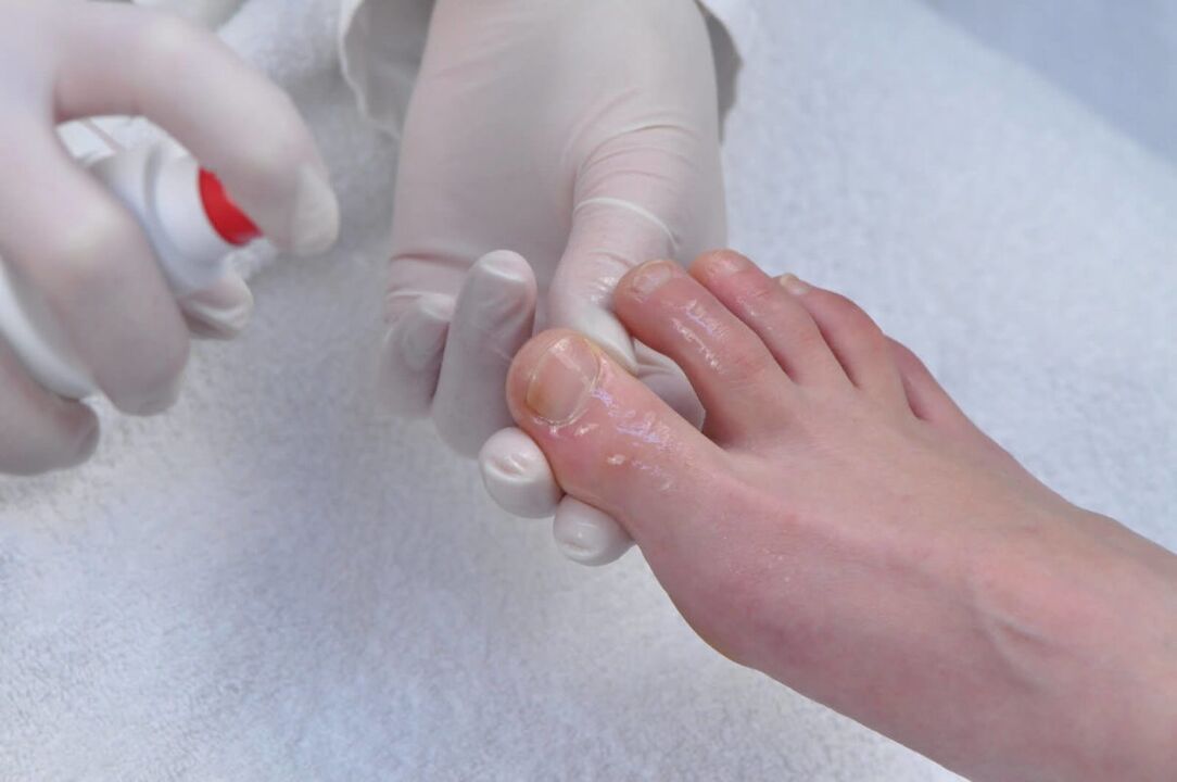 spray pour le traitement des mycoses des ongles