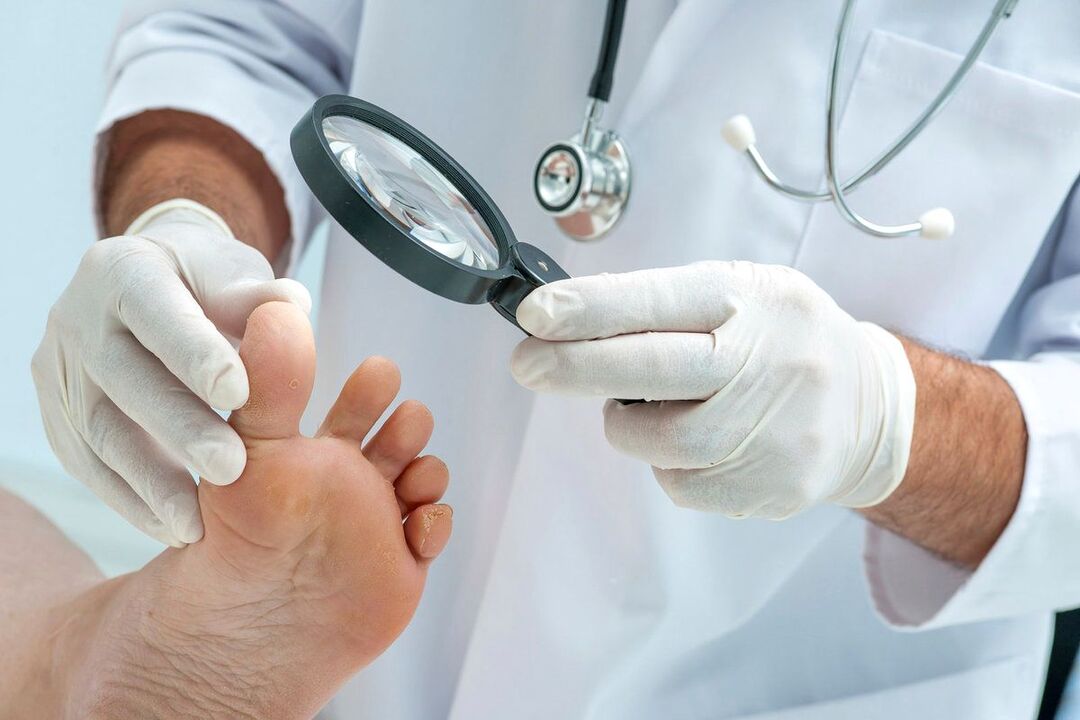 le médecin examine les pieds avec le champignon