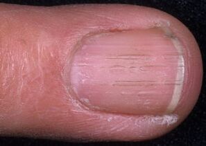 signes de mycose des ongles