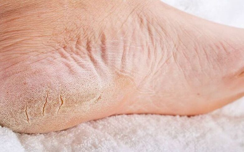 symptômes de champignons des pieds