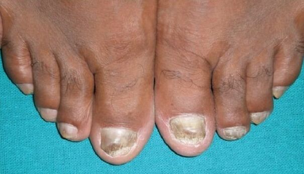 Champignon sur les ongles