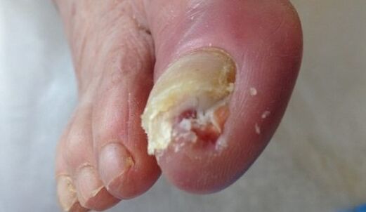 Un ongle malade
