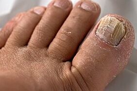 Photo du champignon des ongles