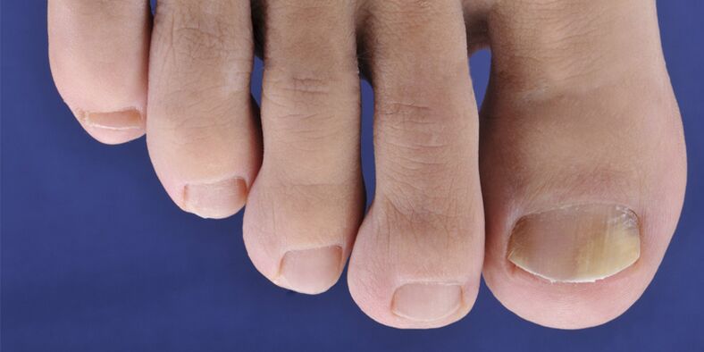 Symptômes de la peau Myque et plaques de ongles