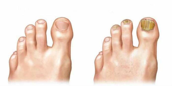 Quel champignon sur les ongles