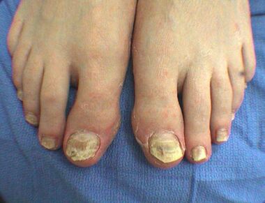 Symptômes des champignons à ongles