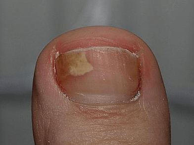Champignon sur le côté gauche de l'ongle