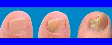 Phase du développement du champignon sur les doigts des pieds