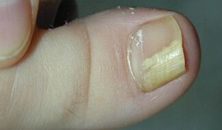 Signes et symptômes du champignon des ongles