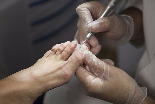 Diagnostic du champignon des jambes