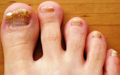 ongles affectés par des champignons