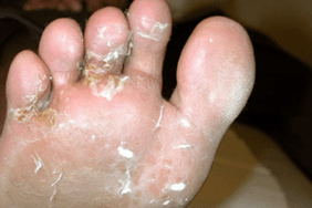 champignons sur les doigts et les pieds