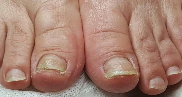 dommages aux ongles avec champignon sur les pieds